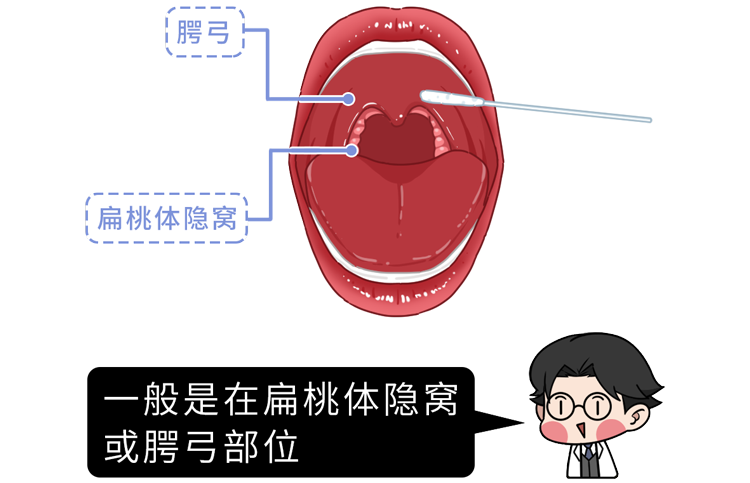 可以看看这张图至于伸去了哪里拭子会伸入你的口腔如图戳喉咙口咽拭子