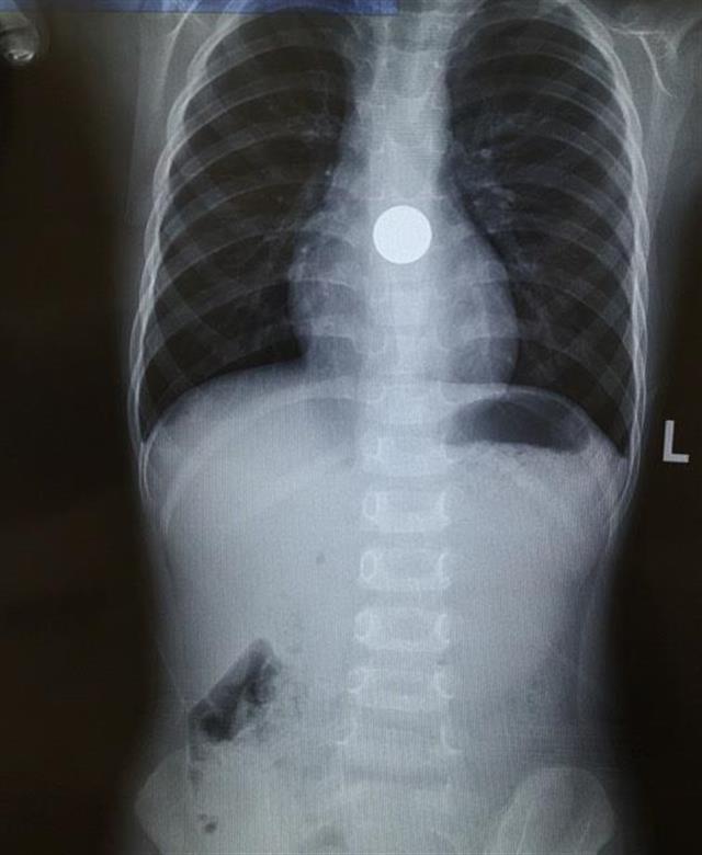 大悟3岁幼儿吞入一角硬币,辗转赴武汉取出