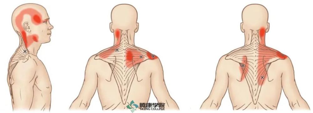 頸部僵硬的關鍵肌斜方肌