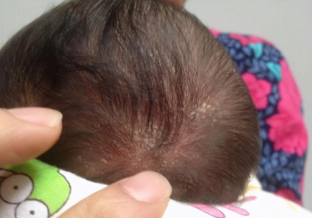 宝宝头上的乳痂要不要管?盲目的做法会害了娃,正确的做法在这里
