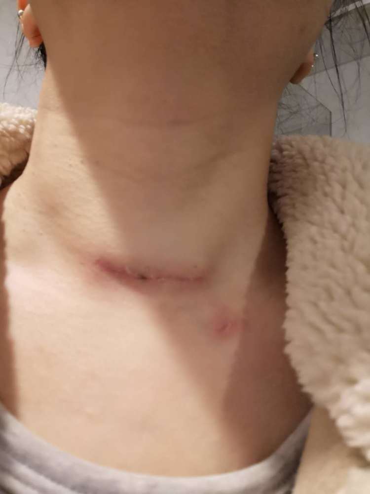 甲状腺癌全切手术住院那几天有图有真相