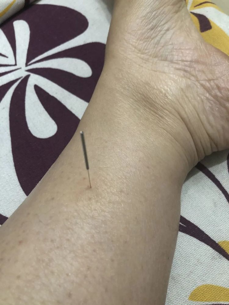 2灸法温针灸2壮,百岁灸2壮,可改善血液循环,增强体质.