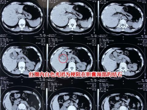 酸误以为是劳累所致,不料是胆囊结石在作怪