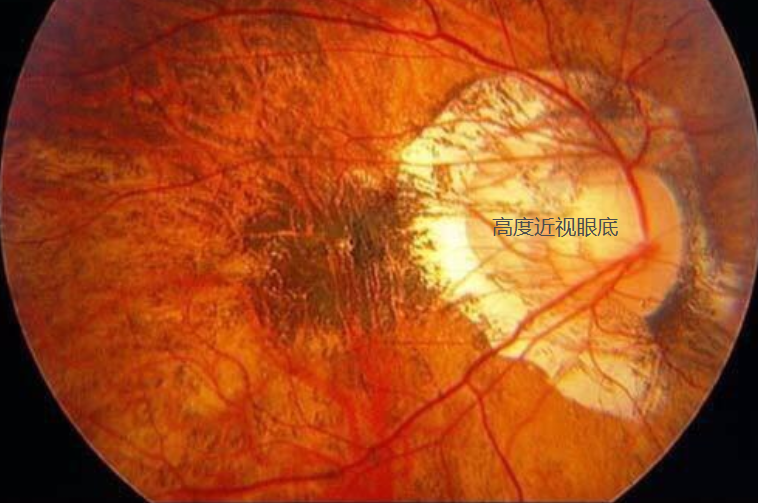 高度近视的危害_腾讯新闻
