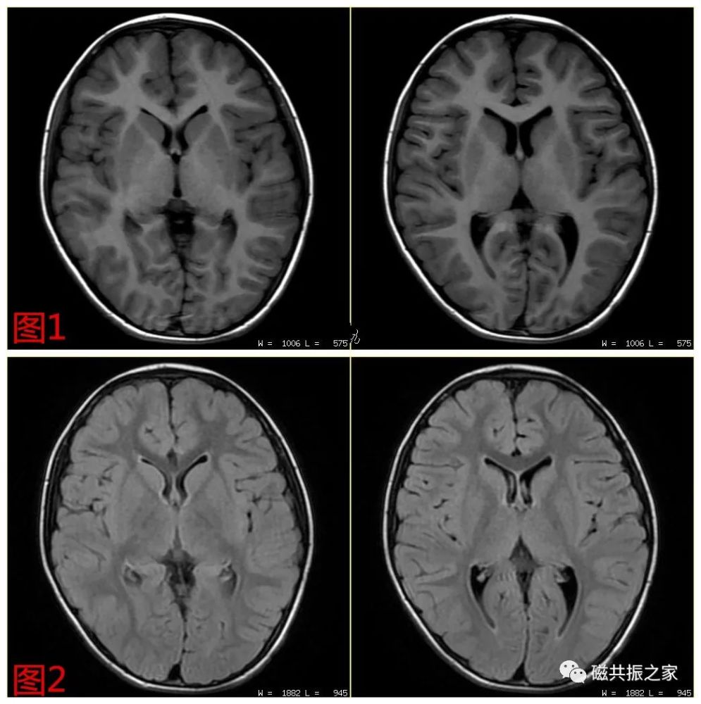 【磁共振基础】让你不再是"权重盲"_腾讯新闻