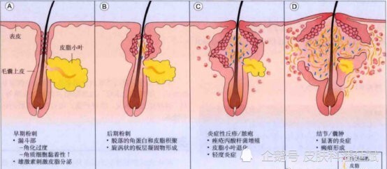 痤疮的发病机制85%以上的青少年都会有痤疮的病史,甚至超过一半的人