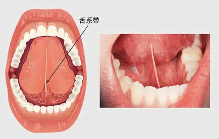 事实上,口里塞布料,正常情况只有一种可能,就是舌头被压在布料下面.