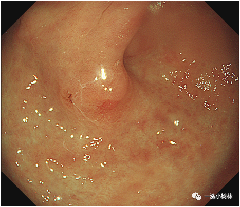 1例早期胃癌病例分享