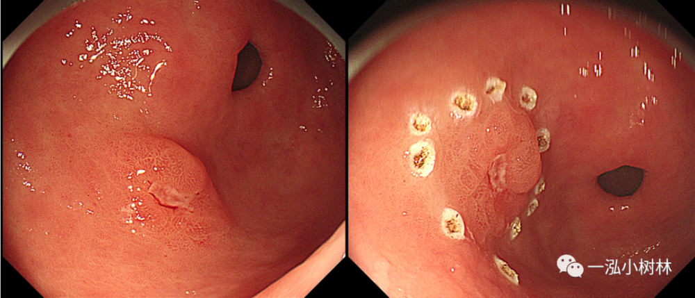 1例早期胃癌病例分享