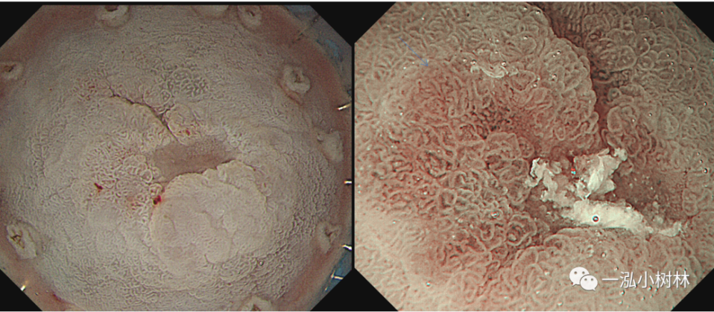 1例早期胃癌病例分享