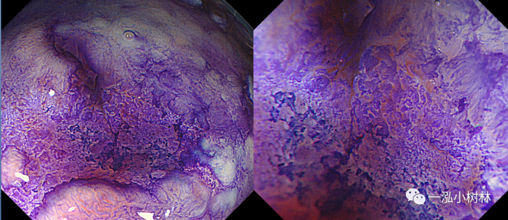 1例早期胃癌病例分享