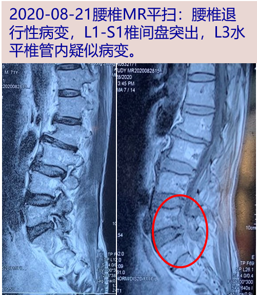 探案丨发热腰疼好不了,原来这只妖孽在作怪!