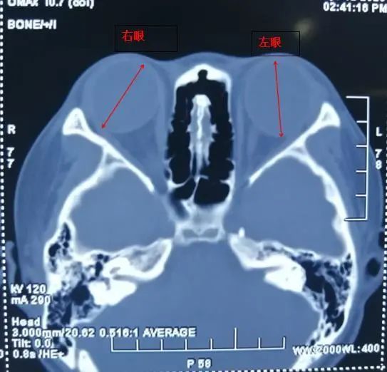 如果能早点做这件事，这对双胞胎姐妹也许不会有2600度的高度近视u2026_腾讯新闻