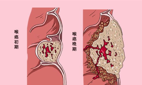 就診,因為喉癌在早期就會出現這種症狀,等到喉嚨部位的癌細胞擴散開來