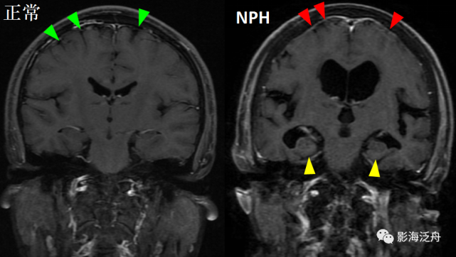 上,可以看到nph患者的側腦室體部,顳角,第三腦室以及外側裂池明顯擴大