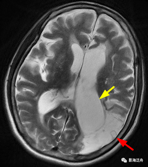 左側顳枕葉軟化灶形成的負佔位效應導致同側側腦室后角明顯擴大,形似