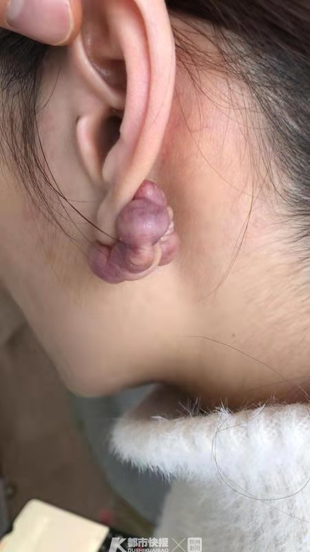 耳洞增生脓包图片