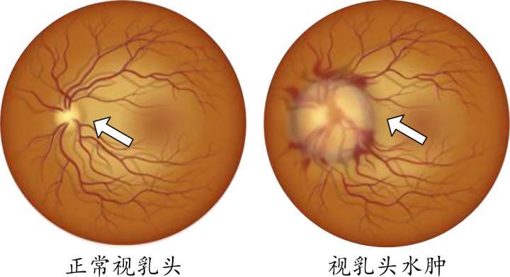 高压综合征,临床症状以头痛,耳鸣,视乳头水肿合并视力下降为主要特点