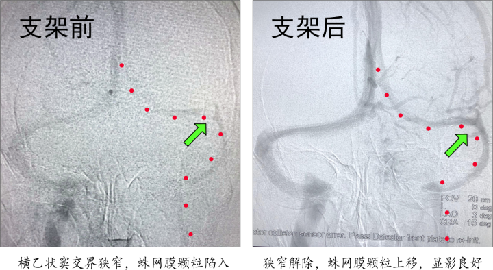 要及时专科就诊,完善磁共振静脉血管造影(mrv)或是全脑血管造影(dsa)