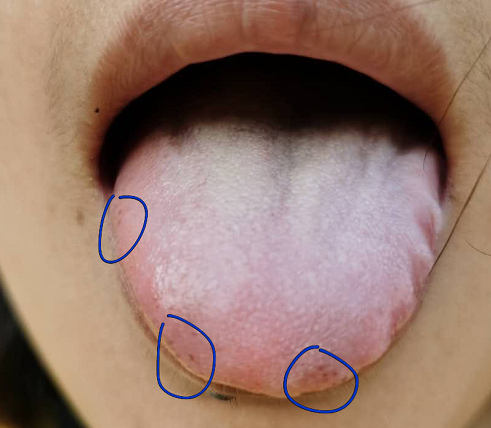 舌头边有黑斑的图片图片