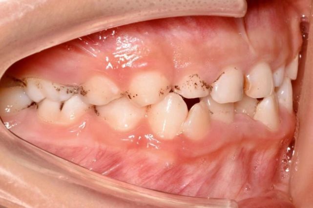 小朋友牙齿上的黑色素能去掉吗