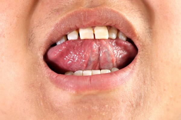 观察舌头下的青筋能够知道血管有无堵塞吗舌筋变粗是咋回事