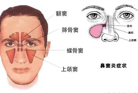 鼻炎鼻窦炎,虽然一字之差,但确是完全不同的鼻部疾病