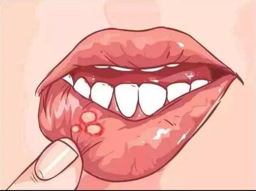 口腔溃疡是放射性口腔黏膜炎的症状,是癌症患者在治疗过程中比较常见