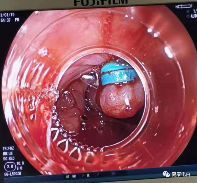 茂名市电白区人民医院成功抢救上消化道出血患者