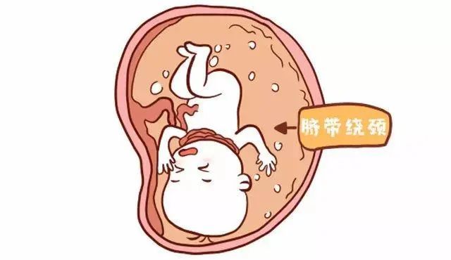 10个胎儿9个绕,发现胎儿脐带绕颈怎么办!_腾讯新闻