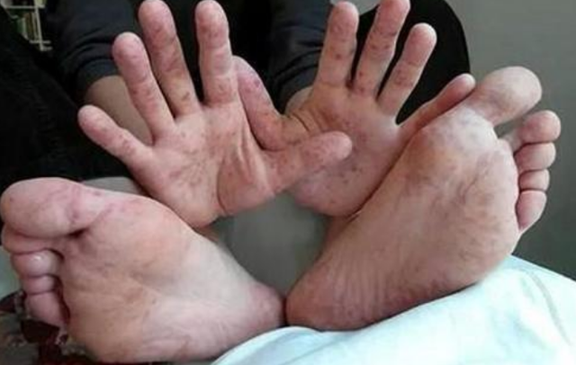 糖尿病手:一种被遗忘的并发症,不妨检查一下自己有没有_腾讯新闻