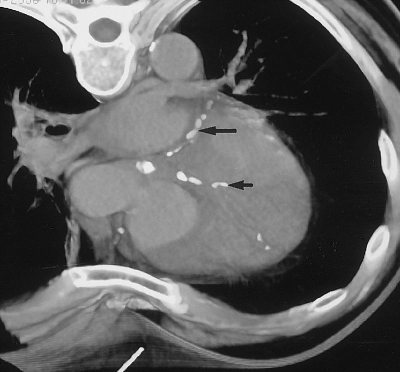 绝大多数朋友得知自己冠状动脉钙化是在筛查胸ct时发现的.