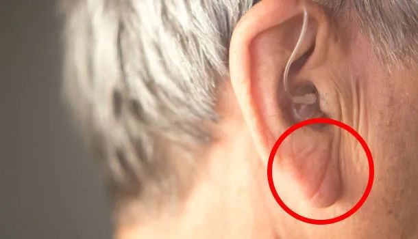 【谣言榜】耳垂有皱褶就会得冠心病?