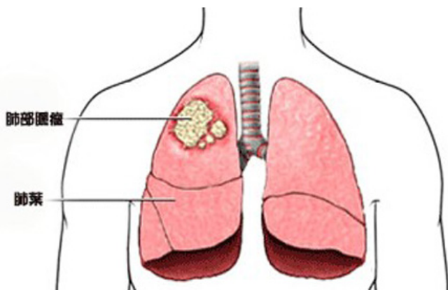 肺结节有什么症状图片