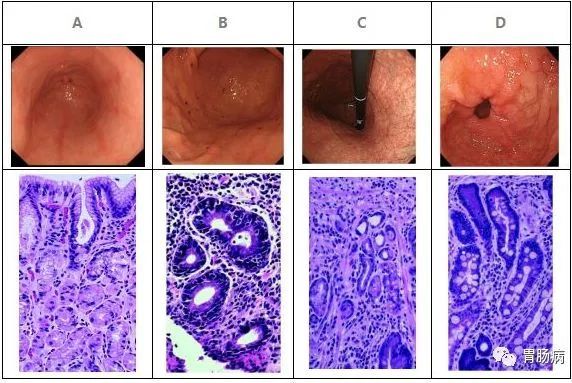 查出来肠上皮化生怎么办