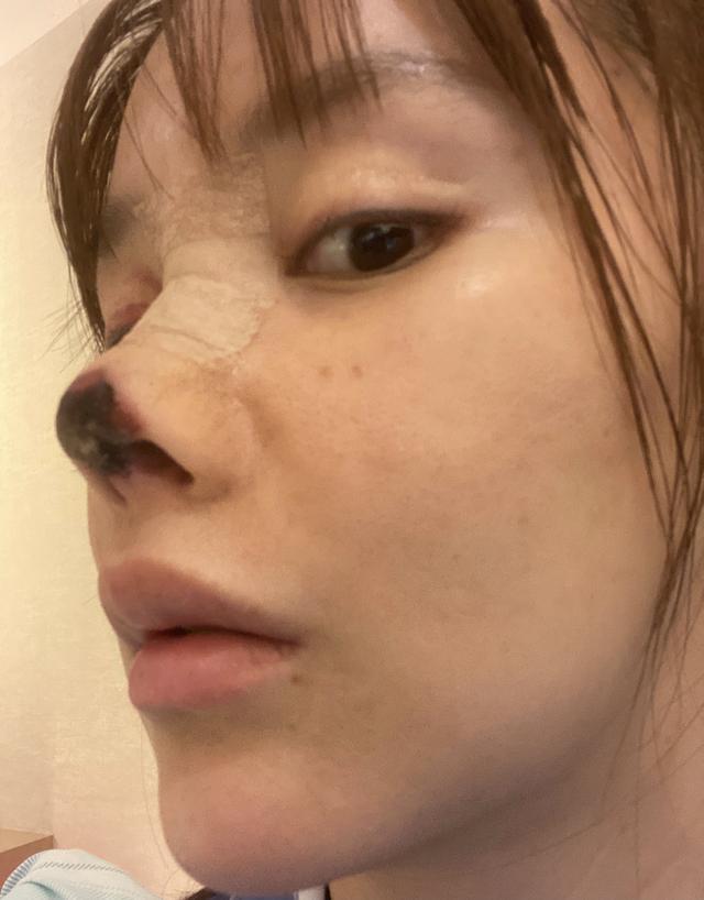 女星自曝整形失败遭毁容,鼻头变黑烂掉好可怕,无法拍戏差点自杀_腾讯