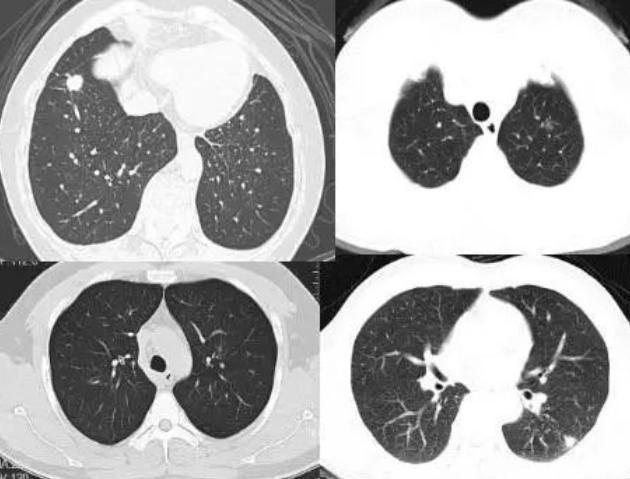 肺部出现结节咋办忌1物吃2果饮2水结节或可慢慢消退