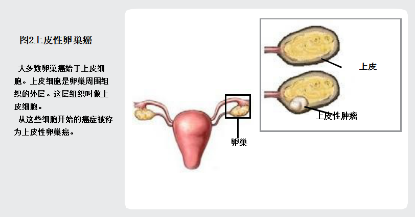 談癌色變之困擾女性的卵巢癌