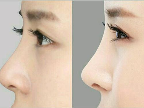 5个鼻部美学标准,教你如何做出完美好看的鼻子!