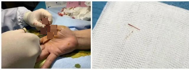 大伯干活玻璃扎进手指又肿又痛无法取出医生提醒勿自行处理