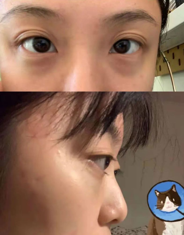 近视度数越高,眼球外突出越明显,看着就像金鱼的眼睛,散涣无神