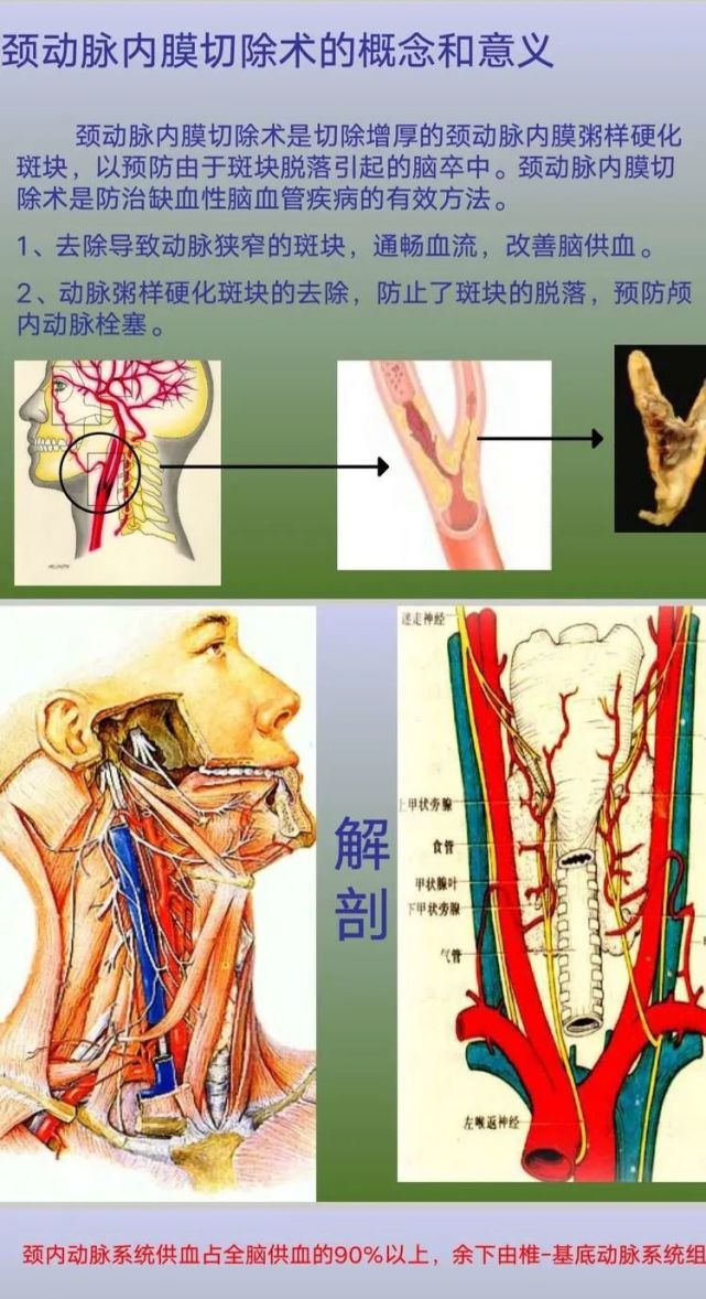 【手術筆記】頸動脈粥樣硬化斑塊及內膜剝脫手術的配合