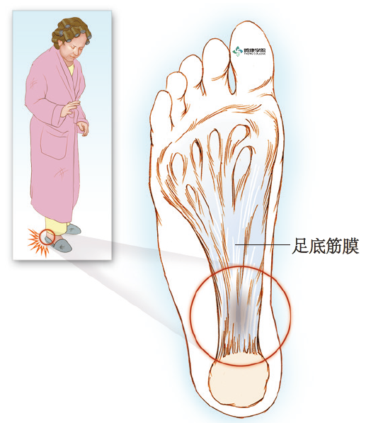 疼痛解剖学足底筋膜炎