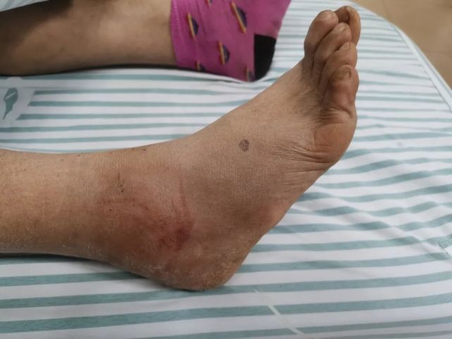 蛇出没丽水一女子被绿色毒蛇咬伤天气渐暖小心