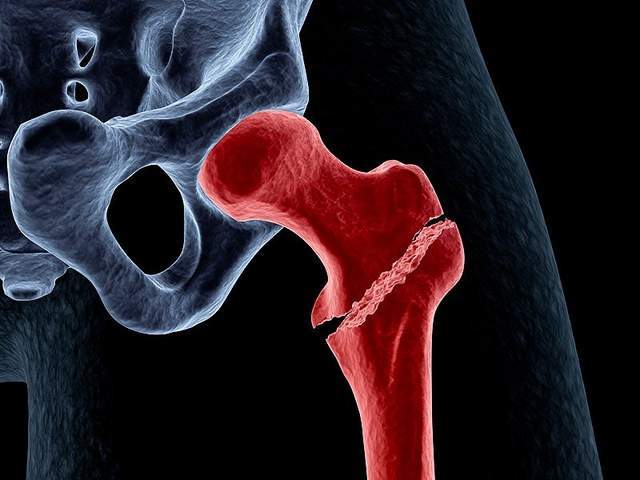 高龄老人髋部骨折绝不能手术否则人就没了医生辟谣讲清利弊