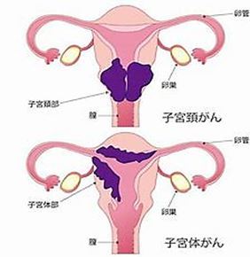 Jmt日本 子宫癌之是什么 类型及症状 腾讯新闻