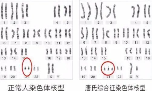 医院做唐氏筛查,医生要求她做羊水穿刺,曹女士就纳闷了,大宝一切正常