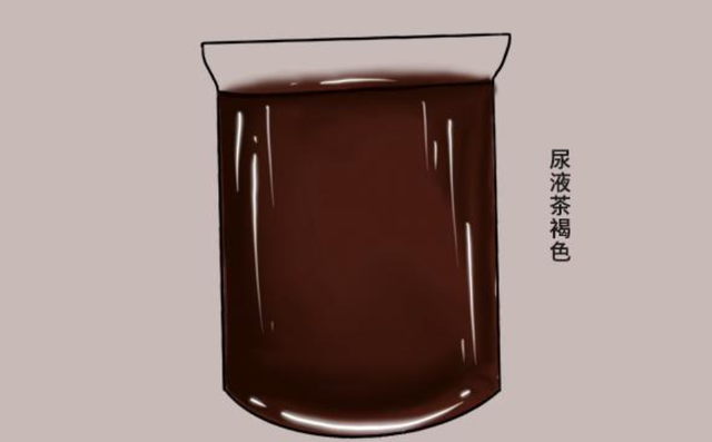 肝不好的人,上厕所可能会出现这三种现象,一起来看下吧