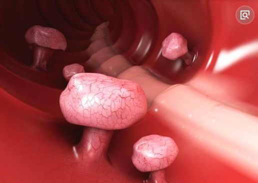 胃息肉|你知道胃息肉吗？不，你不知道！