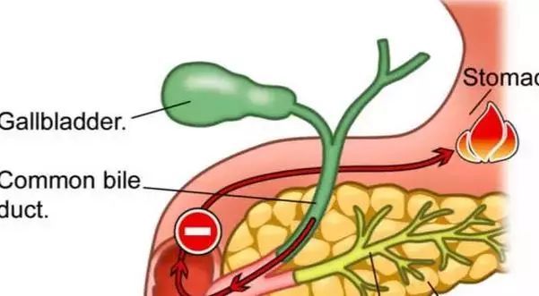 胆汁反流性胃炎|“口苦”是不是得了胆汁反流性胃炎？
